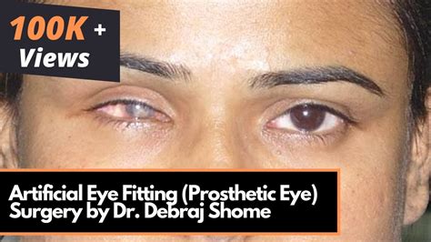 Celebrities With Prosthetic Eyes