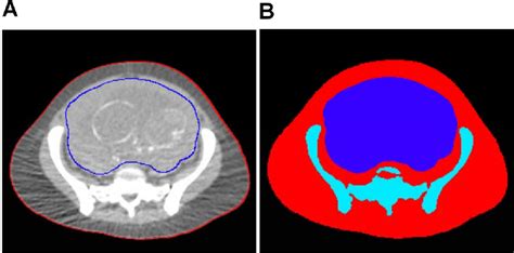 Figure 1 From Patient Specific Computational Model And Dosimetry