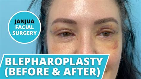 Before And After Of Blepharoplasty Day By Day Results Dr Tanveer Janjua New Jersey Youtube