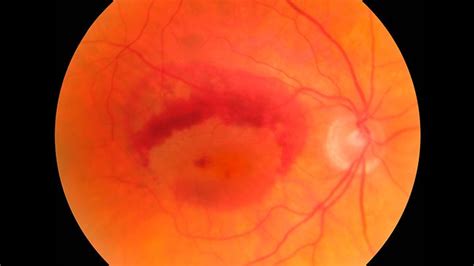 What is Wet Macular Degeneration? | Everyday Health