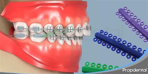 Cuando se usan y para que sirven los elásticos de ortodoncia