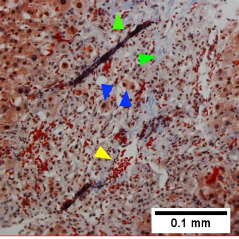 Congestive Hepatopathy Libre Pathology