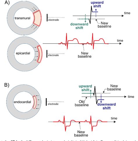 Figure 3 From St Elevation Differential Diagnosis And Caveats A Comprehensive Review To Help