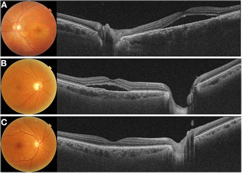 Color Fundus Photograph And Swept Source Optical Coherence Tomography