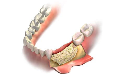 Dental Bone Graft And It Cost Voss Dental Oral Surgery Implant