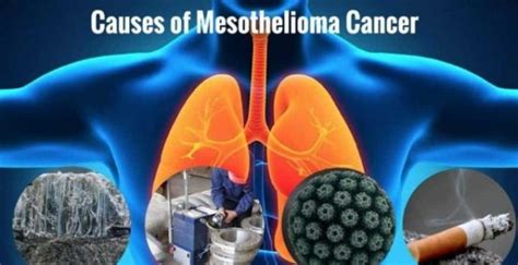 Mesothelioma Causes Symptoms And Treatment Options The Power Of