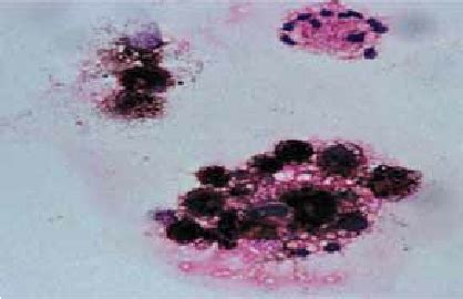 C Cerebrospinal Fluid Cytospin Showing Melanin Containing Cells