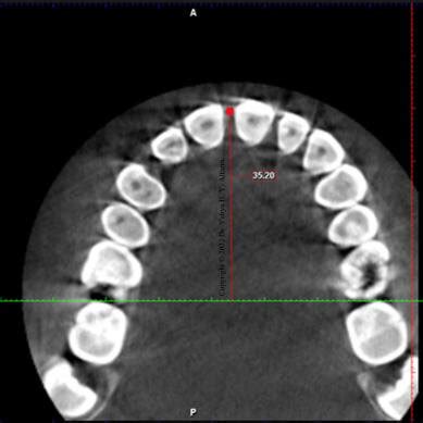 A CBCT Image Shows The Reference Lines For Measuring Arch Length The