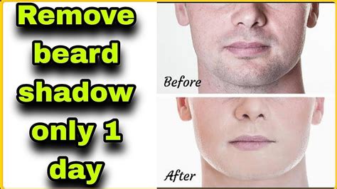 How To Remove Beard Shadow YouTube