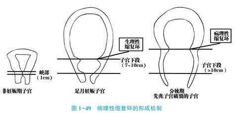 子宫收缩乏力原因——临床助理医师考试