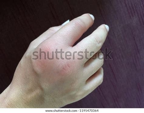 Infection After Bee Sting Swollen Hand Stock Photo 1195470364