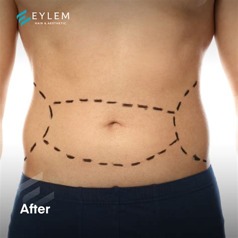 Tummy Tuck Surgery In Turkey Abdominoplasty Eylem Clinic