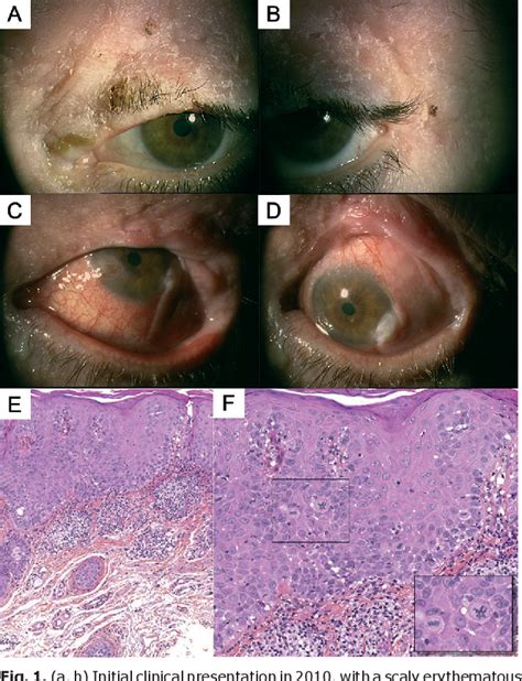 Figure 1 From Unusually Aggressive Actinic Keratosis Of The Eyelid And