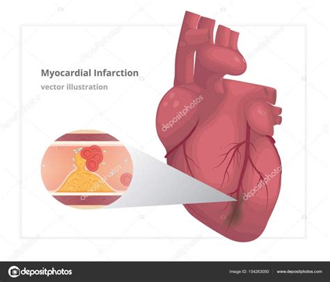 Myocardial Infarction Vector Illustration Cardiac Infarct Stock Vector