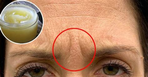 Rides entre les sourcils Apprenez à les éliminer avec une crème maison