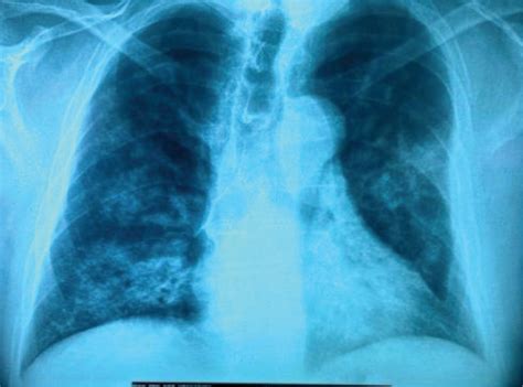 Lung infiltrates and fever: Is it pneumonia or not?