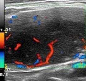 Longitudinal ultrasound scan of the left submandibular swelling shows a ...