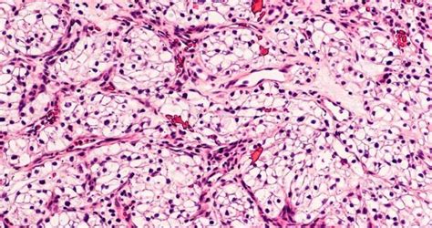 Carcinoma de células renales cinco cosas que debe saber