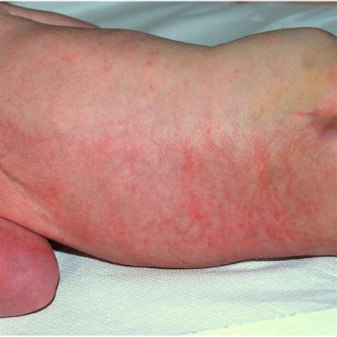 Diffuse Erosions And Ulcerations Covered With Pseudomembrane Download Scientific Diagram