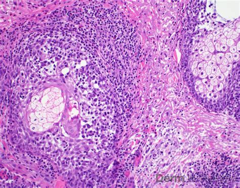 Figure 5.18.7 Mycosis fungoides. – Derm In-Review