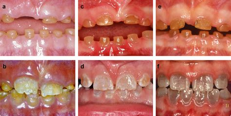 Osteogenesis Imperfecta Teeth