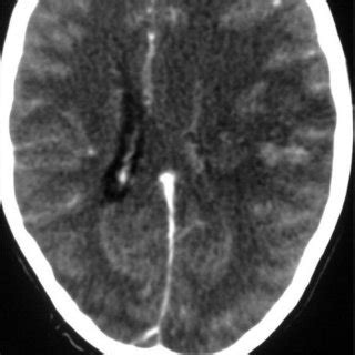 Contrast Enhanced Transverse Ct Image Showing The Empty Delta Sign In