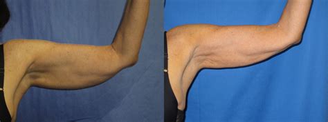 Liposuction Arms Axillary Before After Pictures Case Coeur D