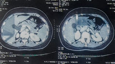 Normal Lipase Pancreatitis: A Case Report | Auctores