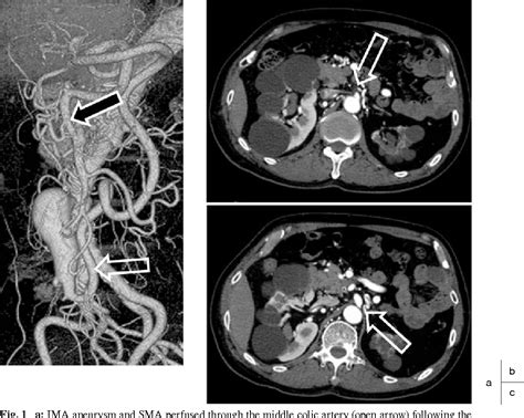 Figure 1 From A Case Of Inferior Mesenteric Artery Aneurysm With An