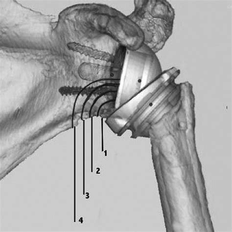 Glenoid Baseplate Positioning At The Inferior Edge Ideally Leads To The Download Scientific