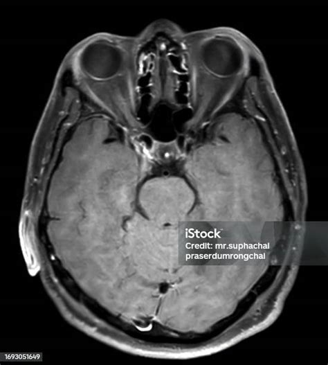 Mri Brain Scan Axial Plane For Detect Brain Diseases Sush As Stroke ...