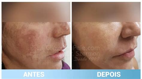 Tratamento Para Melasma Descubra Como Funciona 7 Dermatologia Rio De