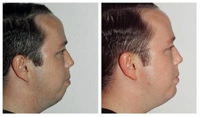 Plastic Surgery Before And After: Chin Augmentation Before And After