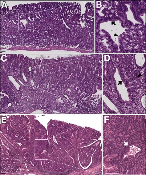 Representative Histologic Features Of Lrig Duodenal Adenomas A