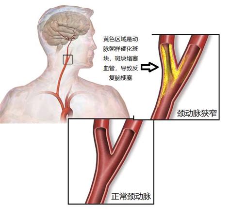 一文读懂颈动脉狭窄 京东健康