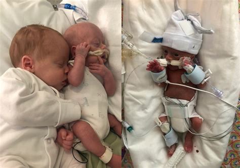 Parents Of Tiny Premature Baby Credit Survival Thanks To Cuddles From