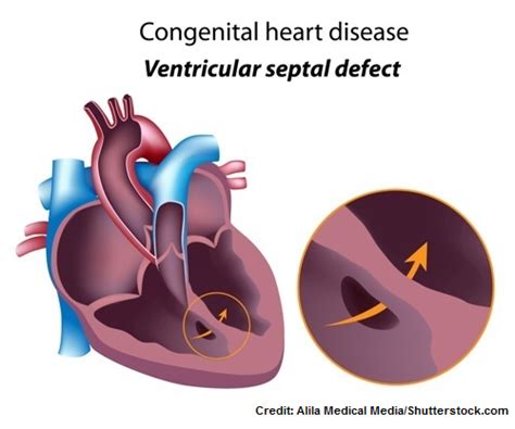 Peds Cardiac Questions Flashcards Quizlet