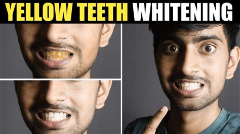 How To Whiten Teeth In Just Mins Yellow Teeth Whitening At Home