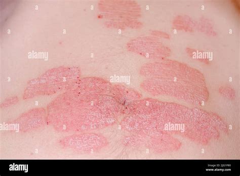 Large Red Inflamed Scaly Rash On The Stomach Acute Psoriasis On The