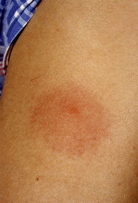 Erythema Migrans Huidhuis