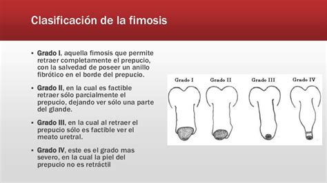 Fimosis En Población Pediátrica