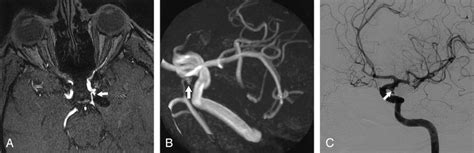 Posterior communicating artery aneurysm with small neck remnant 7 ...