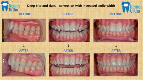 Deep Bite And Class Ii Correction