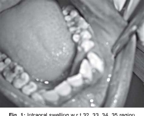 Figure 1 From An Unusual Site Of Adenomatoid Odontogenic Tumor