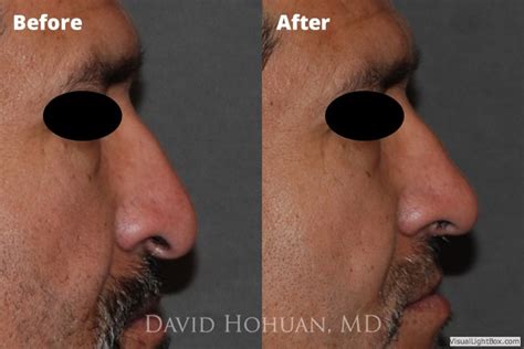 Rhinoplasty Expert Surgeon Yuma Arizona Nose Job David Hohuan Md