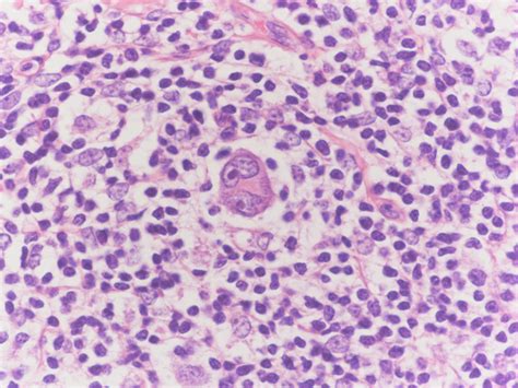 Classical Hodgkin Lymphoma