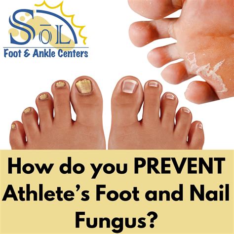 How Do You Prevent Athlete S Foot And Nail Fungus Sol Foot Ankle