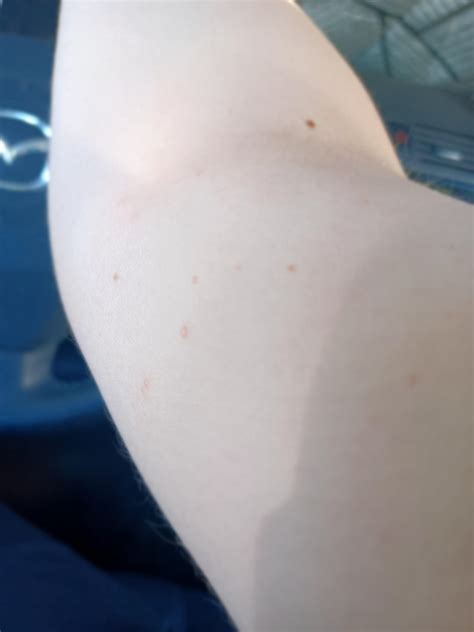 Tiny white bumps? : r/DermatologyQuestions