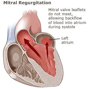 Mitral Regurgitation - York Cardiology