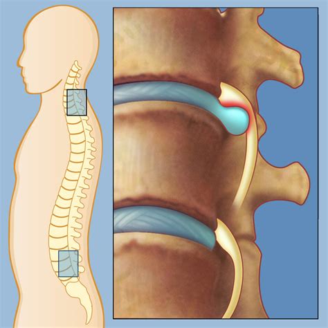 Diagnosing And Treating A Herniated Disc Weill Cornell Brain And